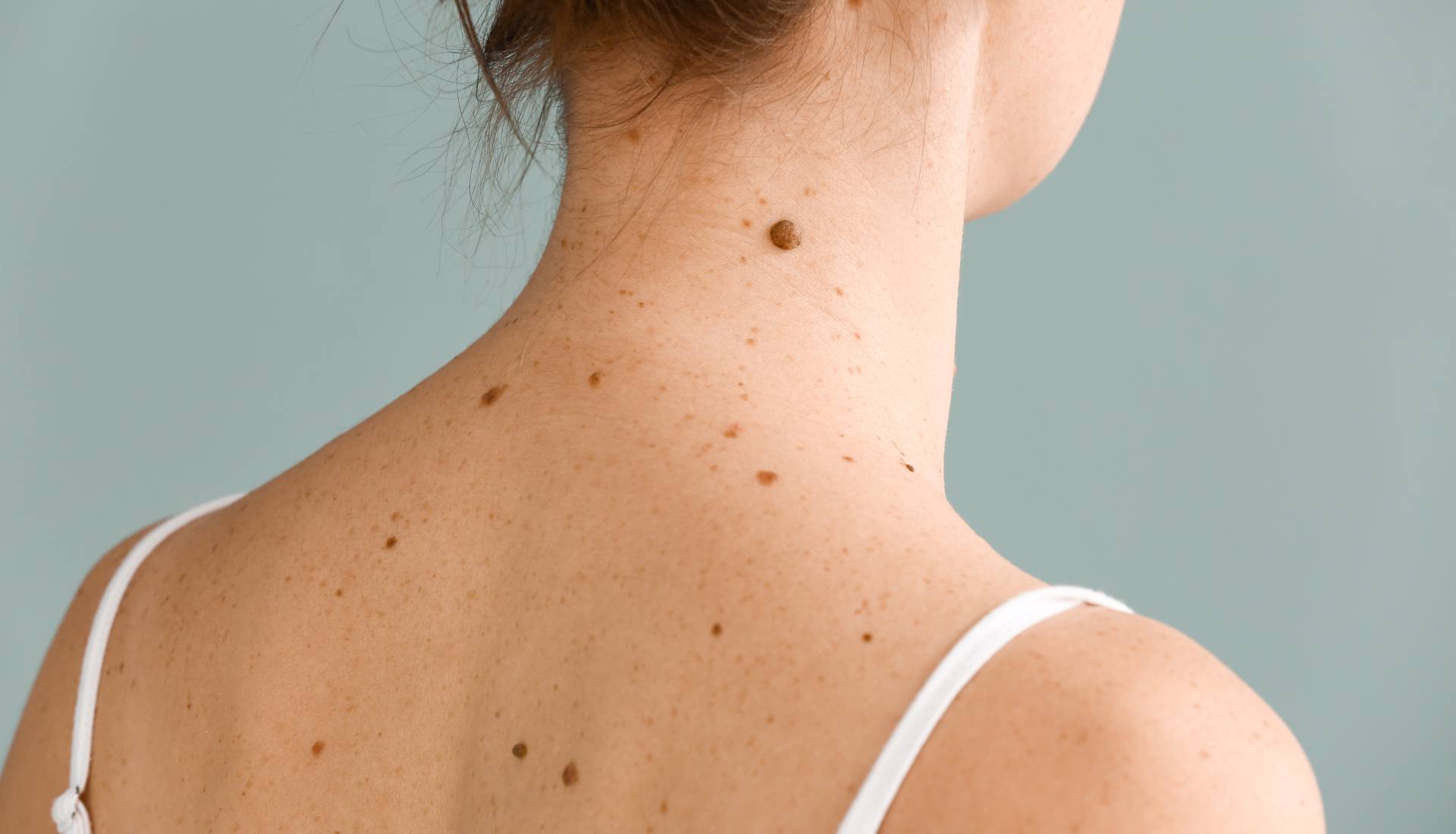 RF-luomenpoisto – tehokas ja turvallinen menetelmä esteettiseen ihonhoitoon Klinikka Luxilla