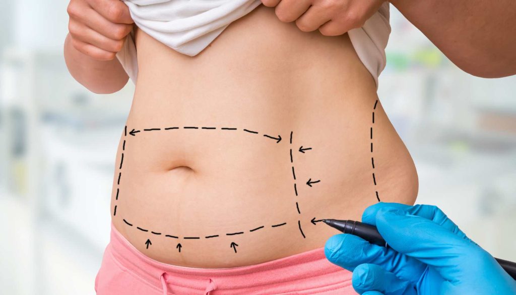 Mommy makeover Suomessa